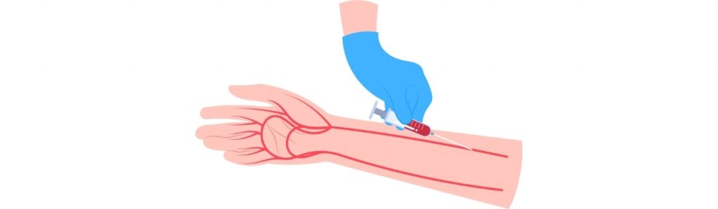 Pose d’une voie veineuse périphérique (VVP) vvp